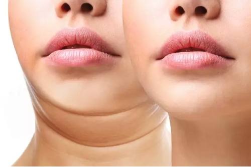 Perfilamiento facial bichectomia en cdmx